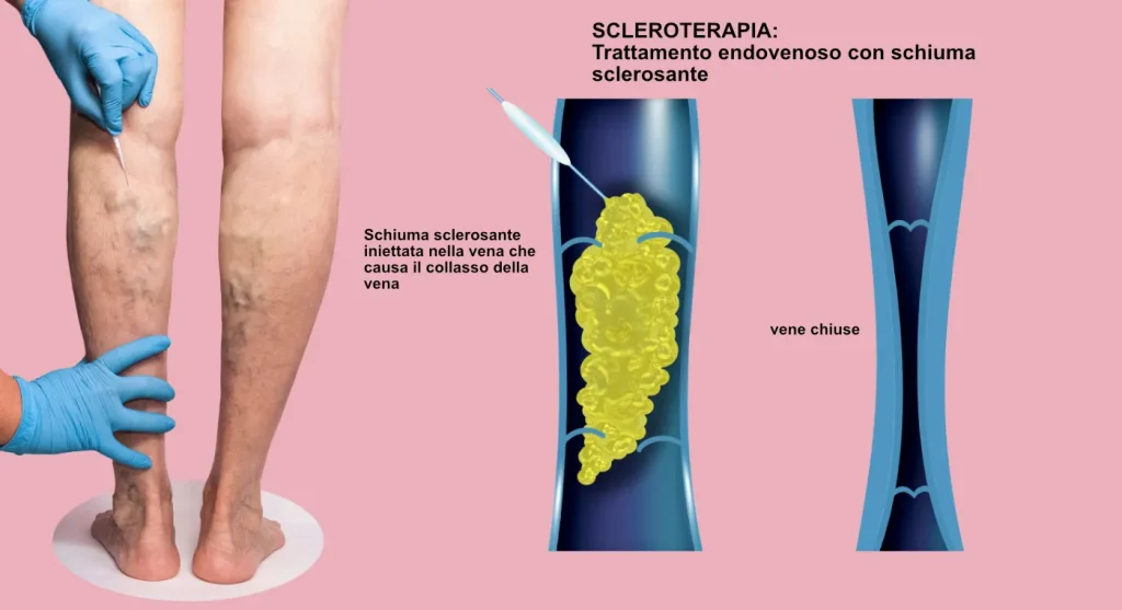 Scleroterapia gambe