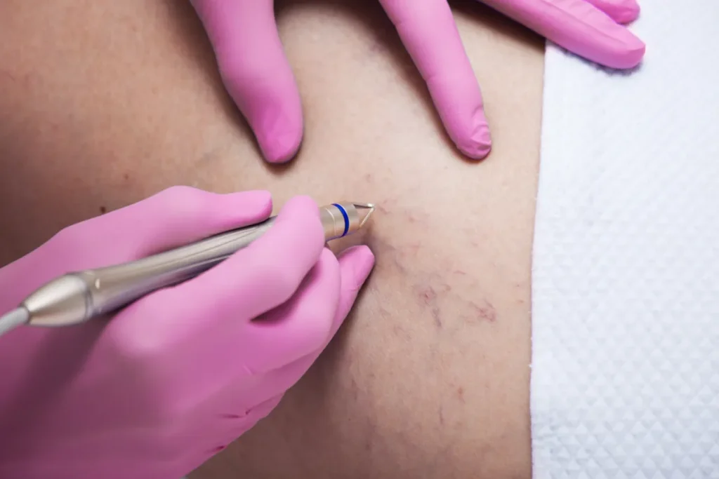 Laser Vascolare capillari