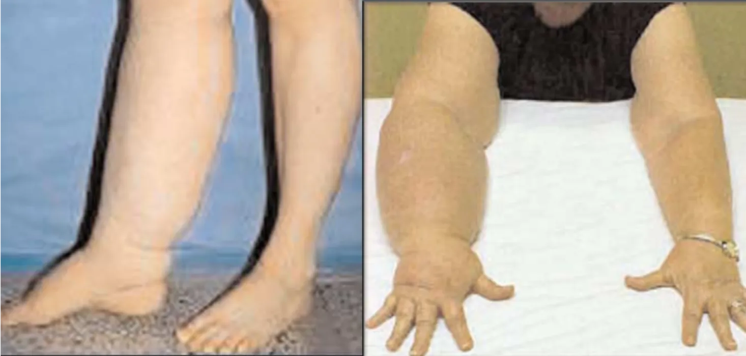 Linfedema agli arti : Gambe e Braccia Linfedema agli arti : Gambe e Braccia