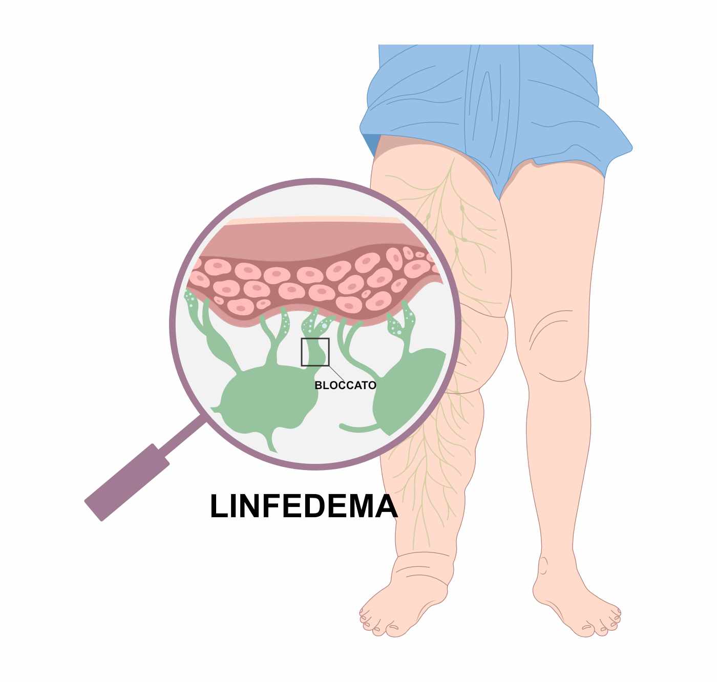 Linfedema-Gamba-Dettaglio