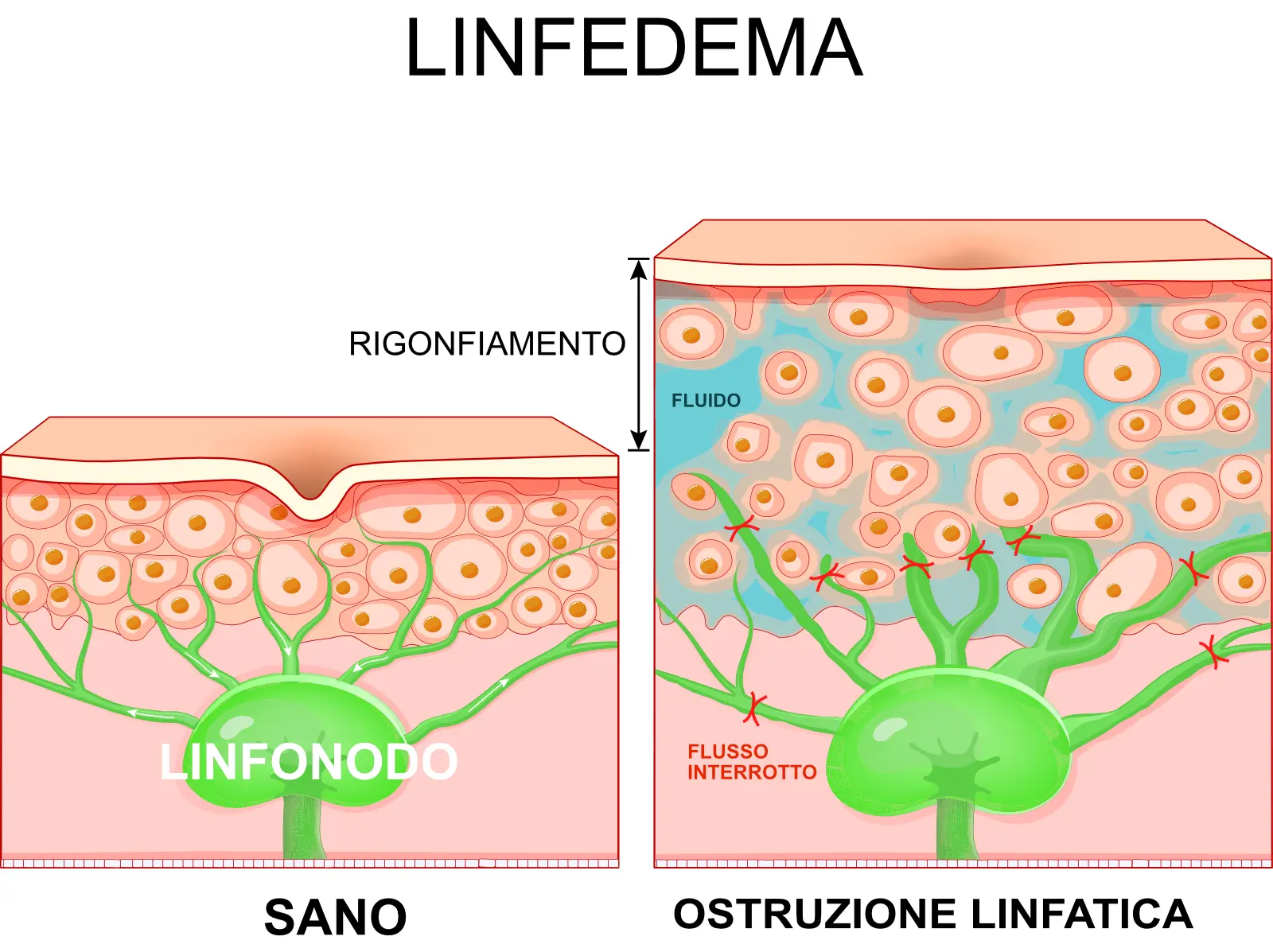 Linfedema - Infografica Linfedema - Infografica