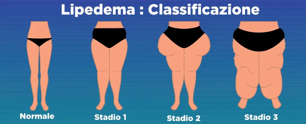 Calssificazione Lipedema: Infografica