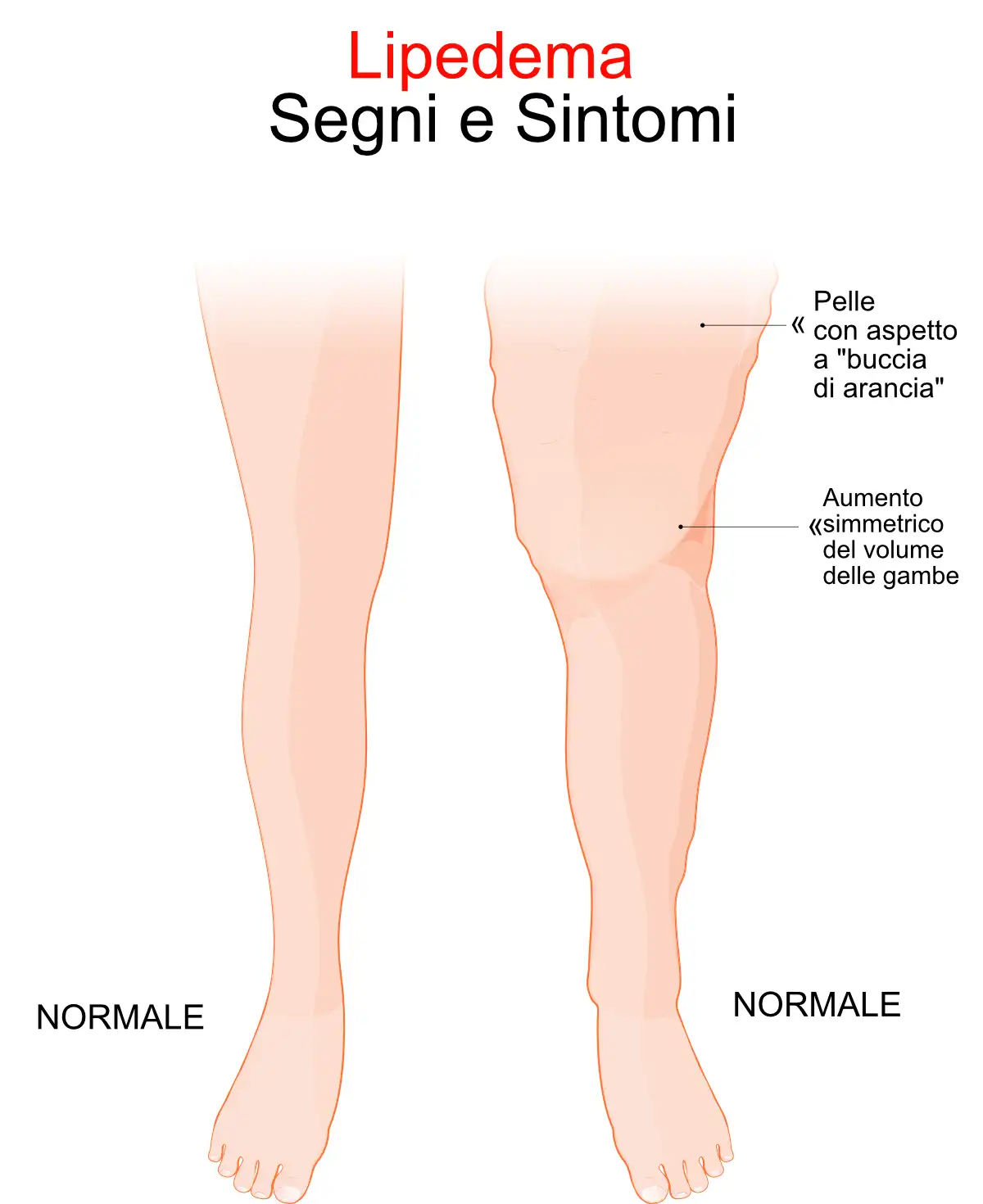 Infografia sintomi lipedema gambe