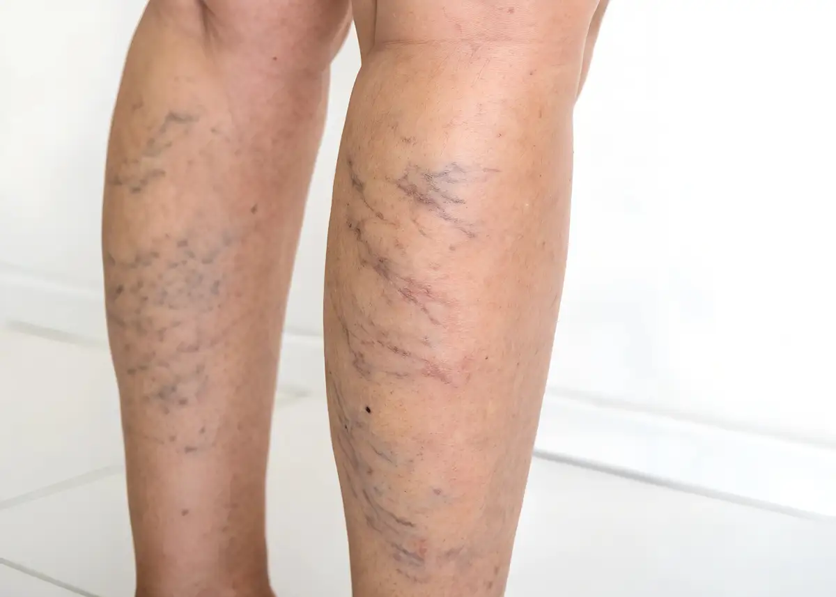 Teleangectasie - Capillari visibili