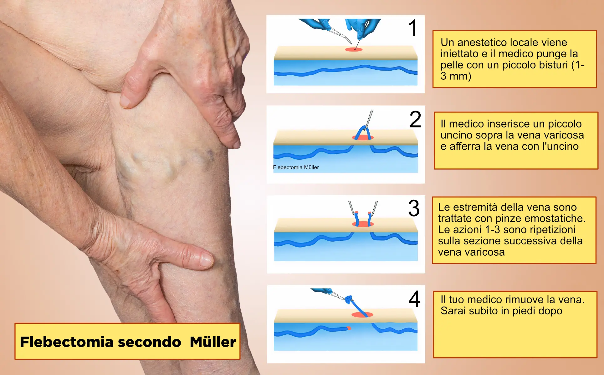 Flebectomia secondo Müller
