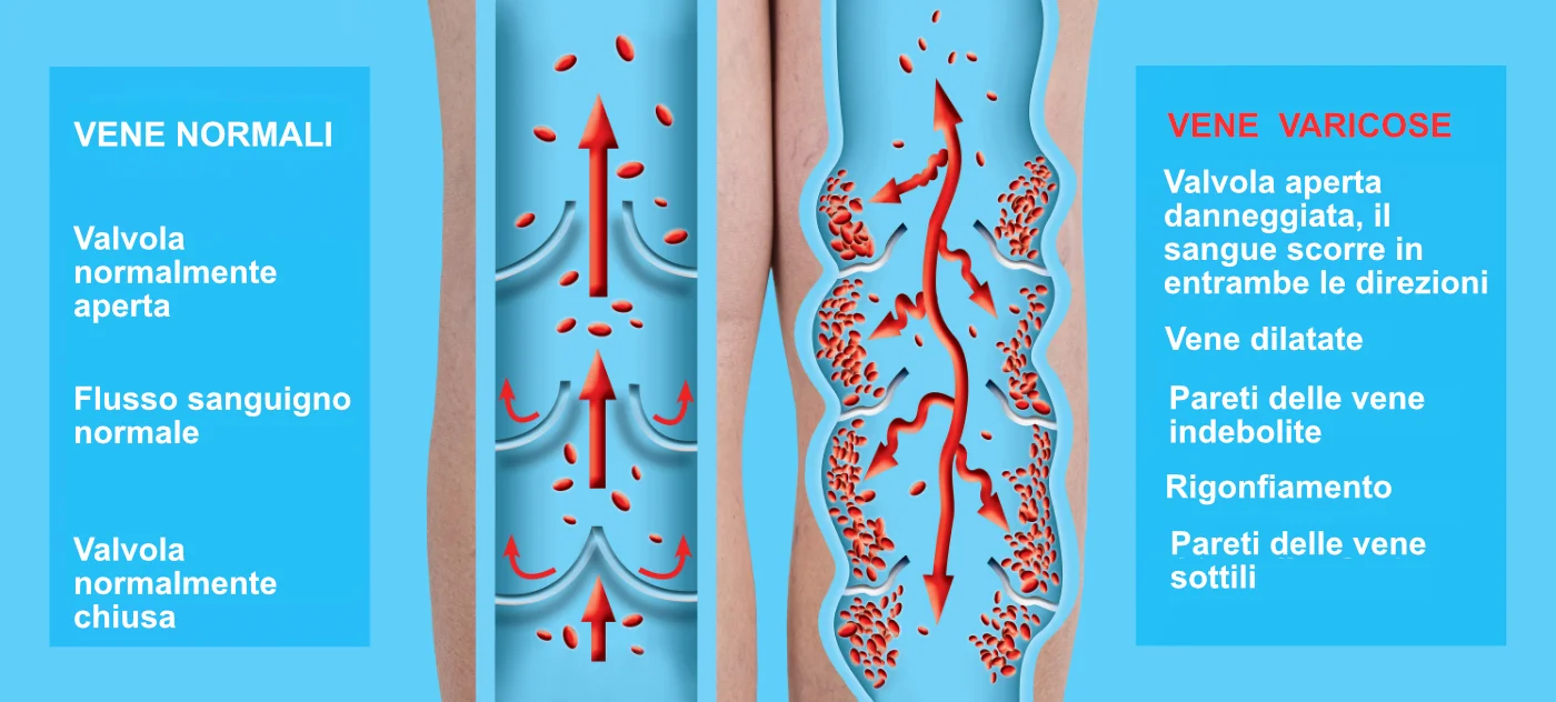Vene Varicose - Flebologia