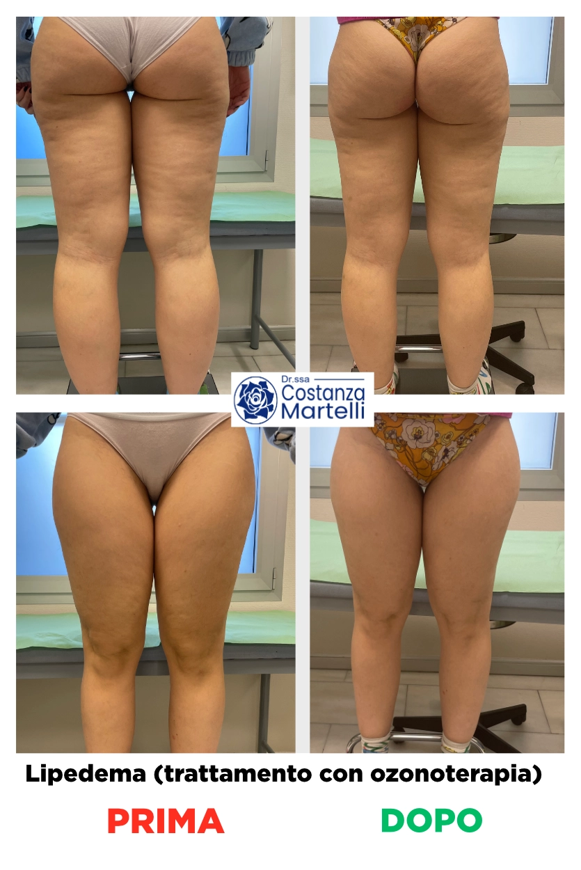 Immagini prime e dopo lipedema, trattato con ozonoterapia