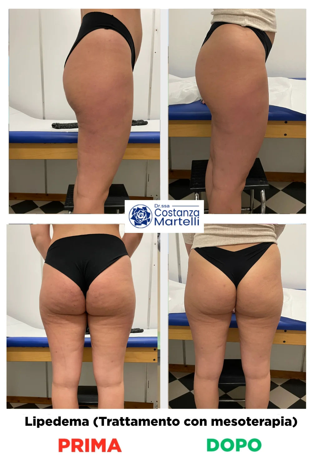 Immagini prima e dopo trattamenti mesoterapia - lipedema Immagini prima e dopo trattamenti mesoterapia - lipedema