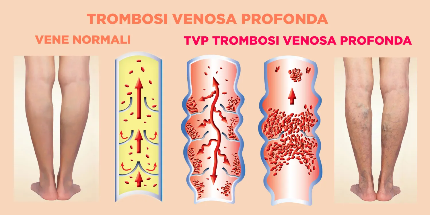 Trombosi venosa profonda  confronto con gambe normali