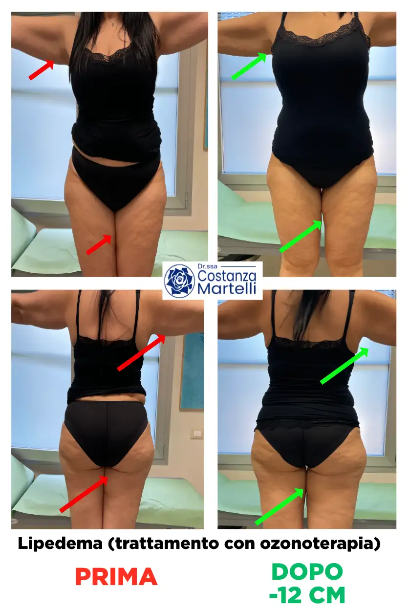Caso di studio di lipedema in donna di 47 anni trattato con ozonoterapia