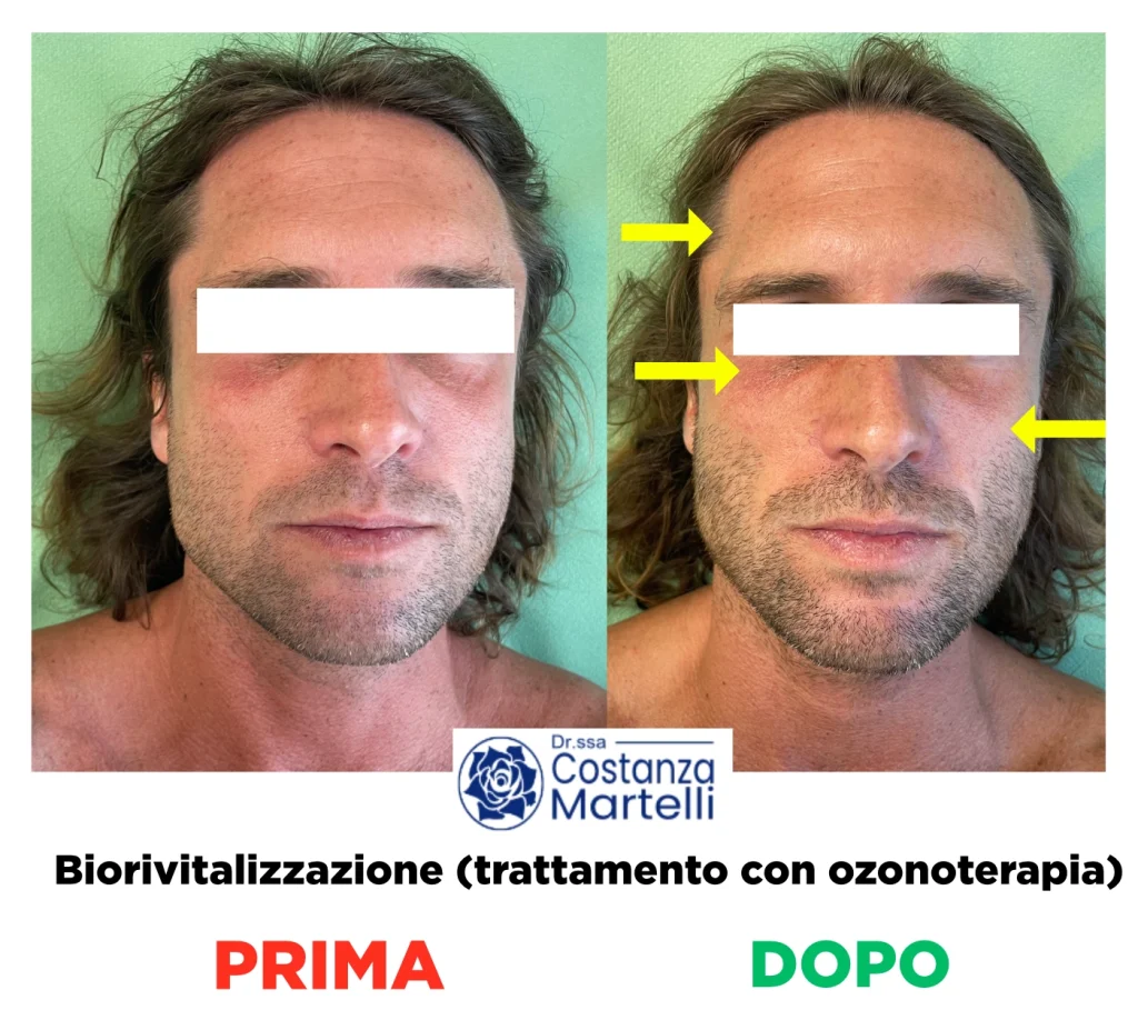 Biorivitalizzazione con ozonoterapia: trattamento antirughe volto