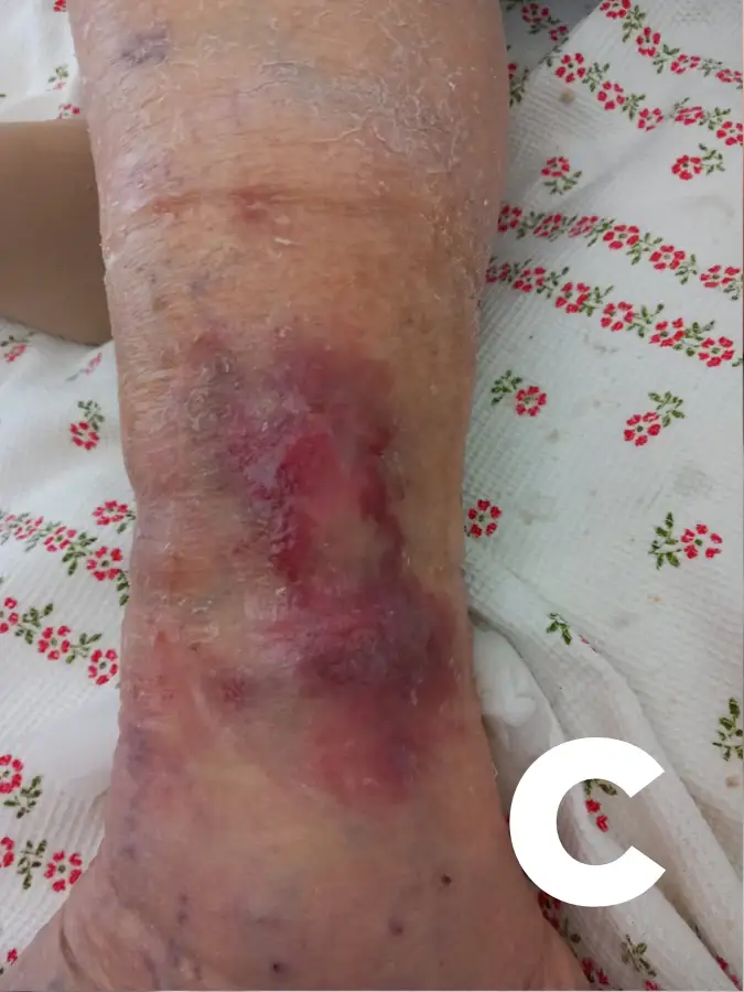 Ulcera venosa trattata a domicilio completamente guarita