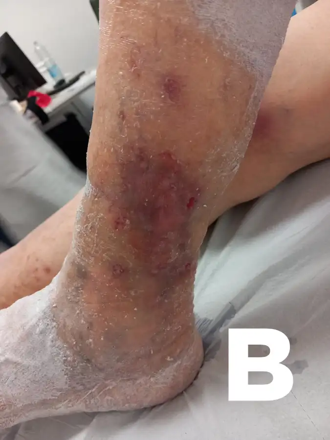 Ulcera venosa dopo trattamenti con ozonoterapia e bendaggi