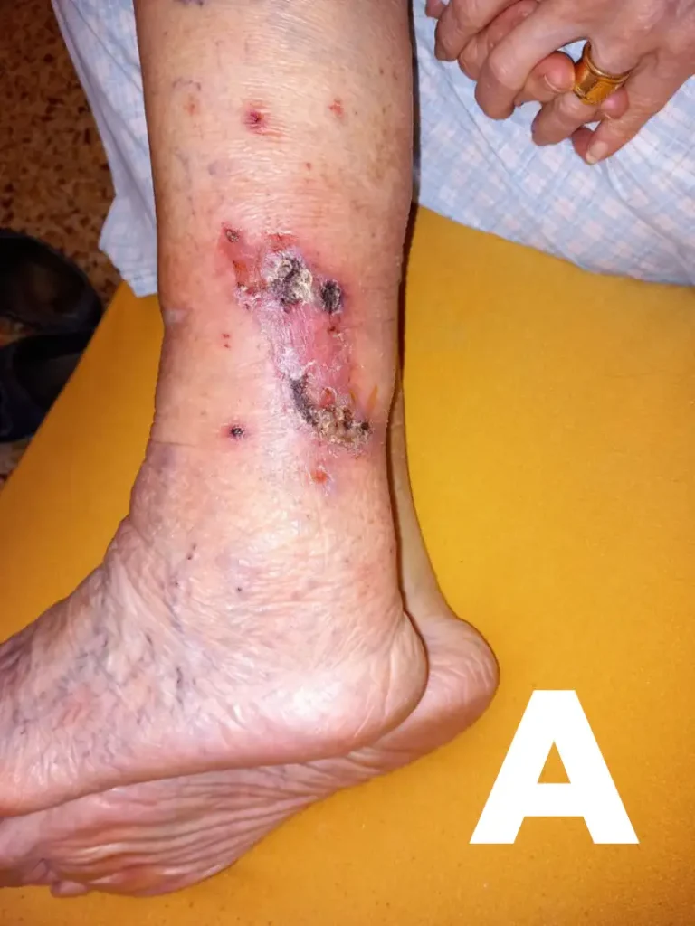 Immagine ulcera venosa gamba